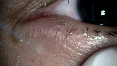 Pimple Popping Extravaganza: A Visual Feast!