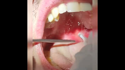 The Great Blackhead Explosion: Prepare to be Amazed!