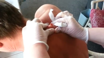 Pop Goes the Pimple: A Delightful Show!