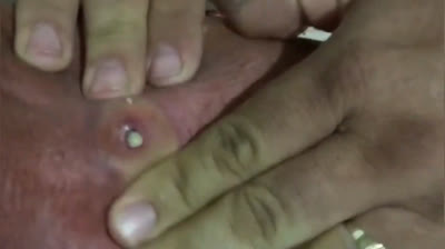 The Ultimate Pimple Popping Showdown: Don't Miss It!