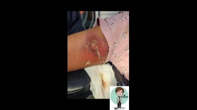 Bursting Blackheads Galore: Dive into the Action!