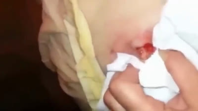 Pimple Popper's Paradise: Where Zits Vanish!