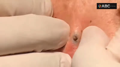 Exploding Pimples: An Unforgettable Experience!