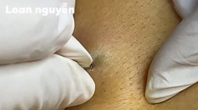 Explosive Blackheads: A Mesmerizing Display!