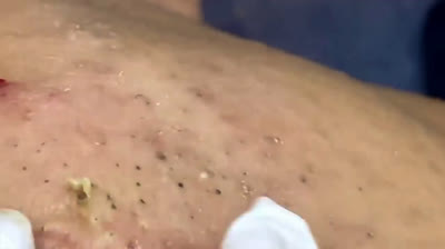 Blackhead Bonanza: Explosions in Every Frame!