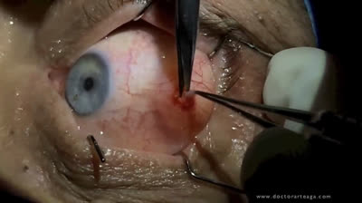 The Great Pimple Purge: Say Goodbye to Imperfections!