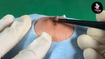 Explosive Pimple Party: Prepare for the Show!