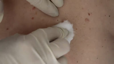 Pimple Pop Parade: A Carnival of Cleansing!