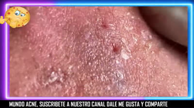 Bursting Blackheads Galore: Prepare for Impact!