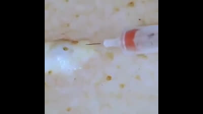 The Great Blackhead Blowout: A Show Not to be Missed!