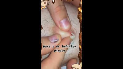 Pimple Pop Showcase: Witness the Magic!