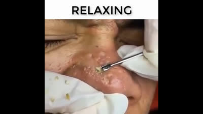 Bursting Blackheads: The Ultimate Cleansing Adventure!