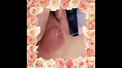 Pimple Pop Phenomenon: A Wonder to Behold!