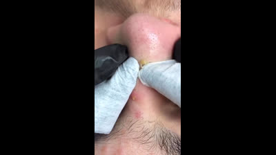 Pore Purging Spectacle: Feast Your Eyes on Clear Skin!