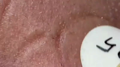 Blackhead Blast: A Symphony of Popping!