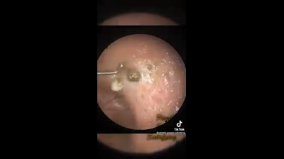 Pore Purging Party: A Celebration of Clear Skin!