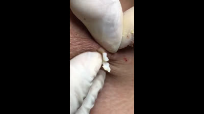 Pimple Pop Spectacular: A Visual Feast!