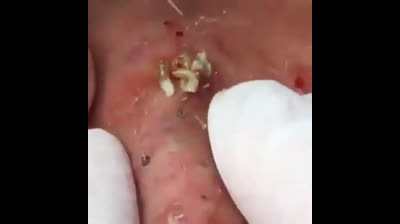 Blackhead Blast-off: Launching into Clearer Skin!