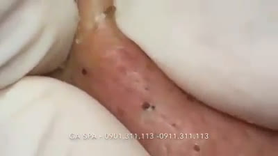 Pore Purging Party: Celebrating Clear Skin, One Pop at a Time!