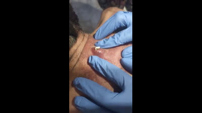 Vidéos d'éclatement de boutons monstrueux