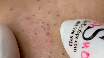 Videos of popping huge pimples