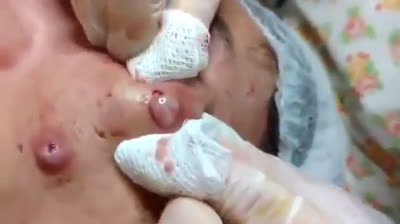 Videos of popping surprising pimples