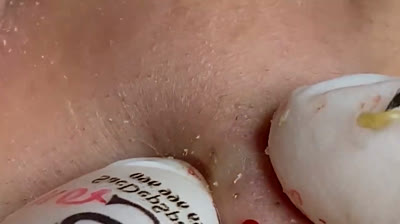 Video di scoppio di brufoli colossali