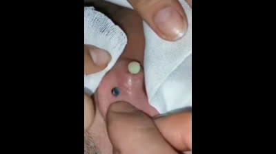 Vidéos d'éclatement de boutons incroyables