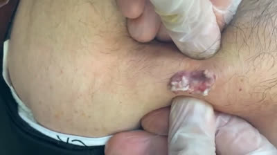 Vidéos d'éclatement de boutons brutaux