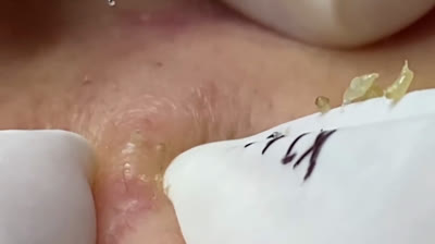 Vidéos d'éclatement de boutons fascinants