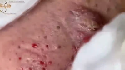 Video di scoppio di brufoli incredibili