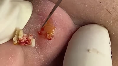 Video di scoppio di brufoli spettacolari