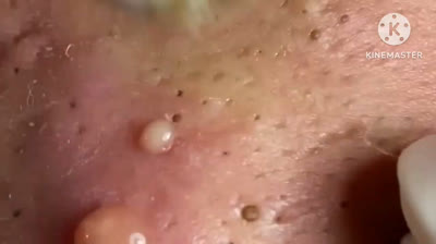 Video di scoppio di brufoli immensi