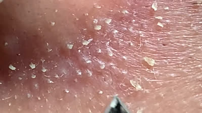 Video di scoppio di brufoli giganteschi