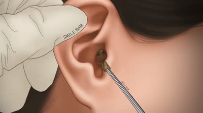 Videos of popping giant shocking pimples