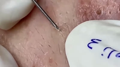 Videos of popping giant satisfying pimples