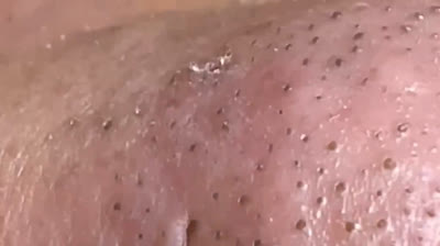 Video di scoppio di brufoli giganti sorprendenti