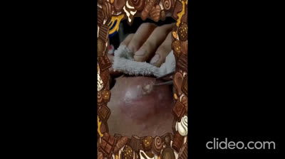 Videos of popping giant impressive pimples