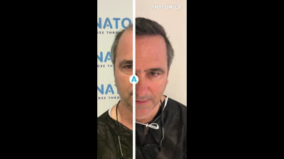 Hair Transplantation with Anatomica Clinic B&A1