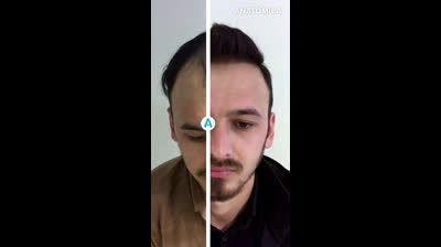 Hair Transplantation with Anatomica Clinic B&A2