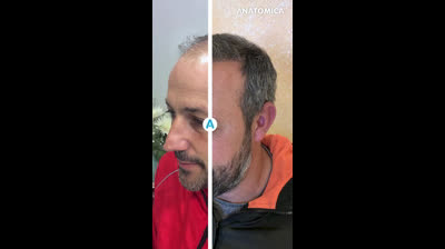 Hair Transplantation with Anatomica Clinic B&A3