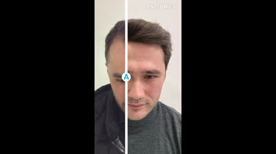 Hair Transplantation with Anatomica Clinic B&A5