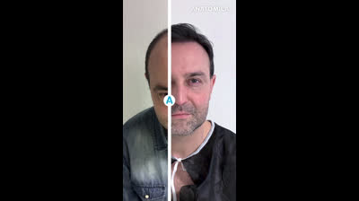 Hair Transplantation with Anatomica Clinic B&A6