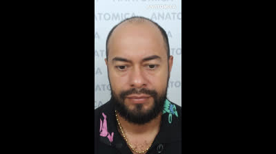 Trasplante capilar en República Dominicana